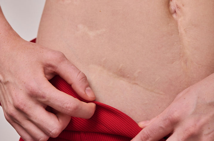 Close-up of young body positive woman showing surgical scar on her body