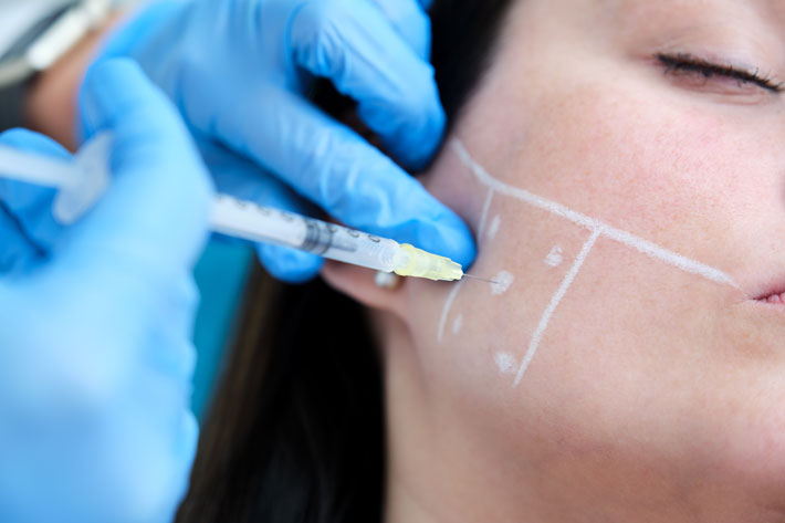 facial marking with white dermoplastic pencil of points for mandibular anti-bruxism treatment with botulinum toxin