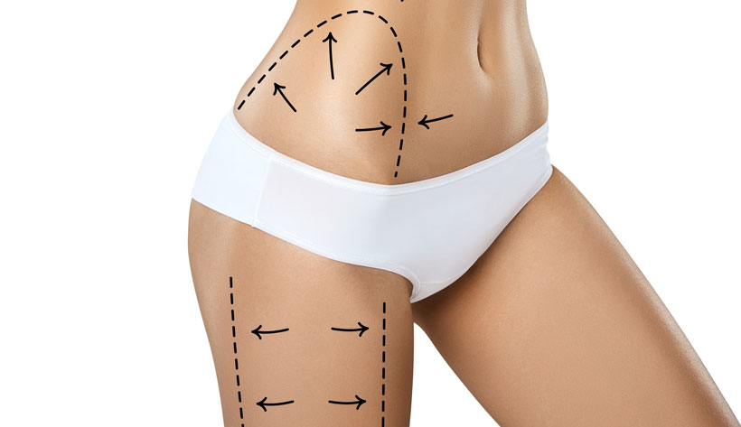 Young woman torso in underwear with the drawing arrows and medical marks. Fat lose, liposuction, cellulite removal and skin lifting concept.