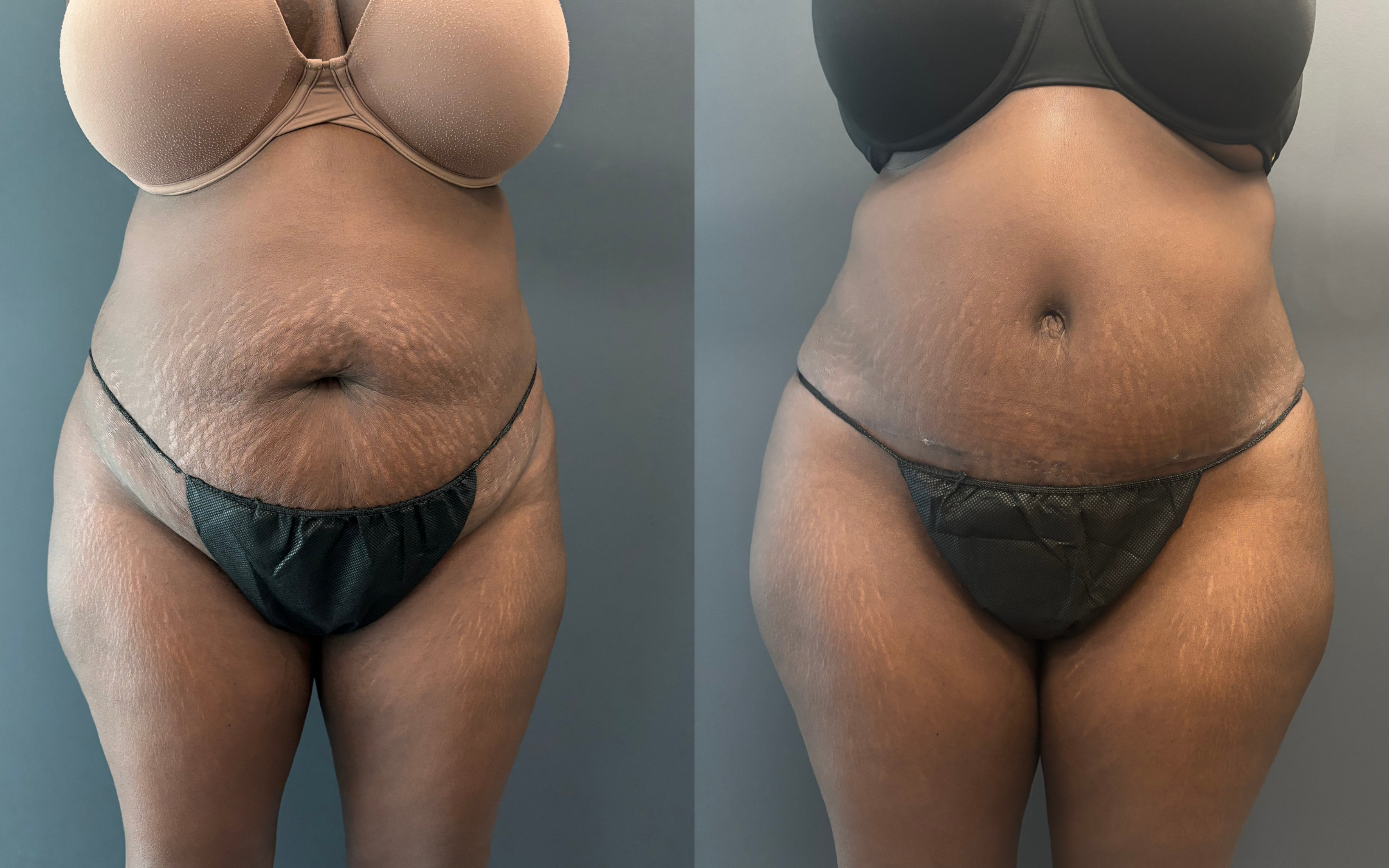 Before and after result 1