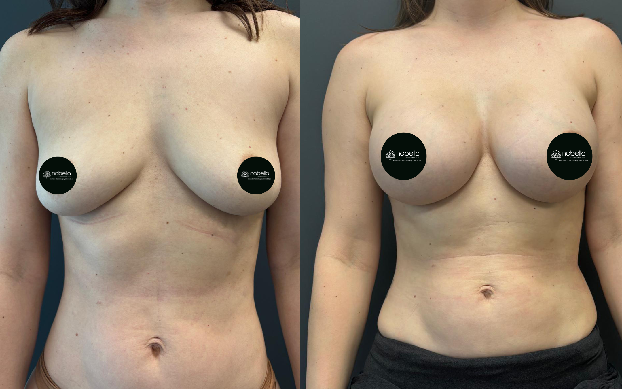 Before and after result 1